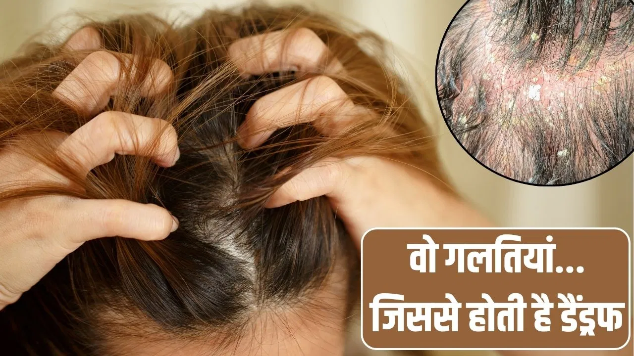 बालों की देखभाल से जुड़ी इन गलतियों की वजह से सिर पर जम जाती है डैंड्रफ की परत बालों की देखभाल से जुड़ी इन गलतियों की वजह से सिर पर जम जाती है डैंड्रफ की परत