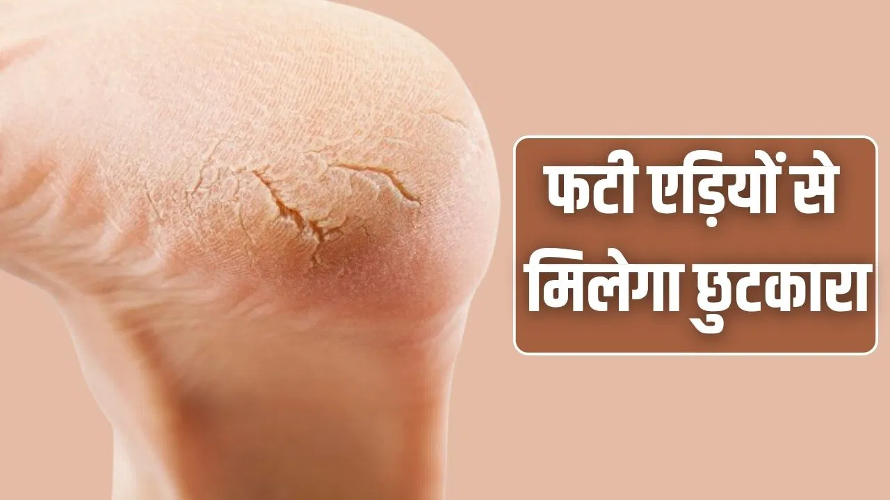 महंगी क्रीम की नहीं पड़ेगी जरूरत, इन नुस्खों से फटी एड़ियां बनेंगी सॉफ्ट महंगी क्रीम की नहीं पड़ेगी जरूरत, इन नुस्खों से फटी एड़ियां बनेंगी सॉफ्ट