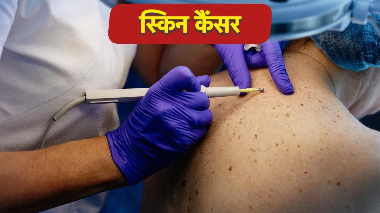 स्किन कैंसर का खतरा किसको होता है? क्या हैं लक्षण? स्किन कैंसर का खतरा किसको होता है? क्या हैं लक्षण?