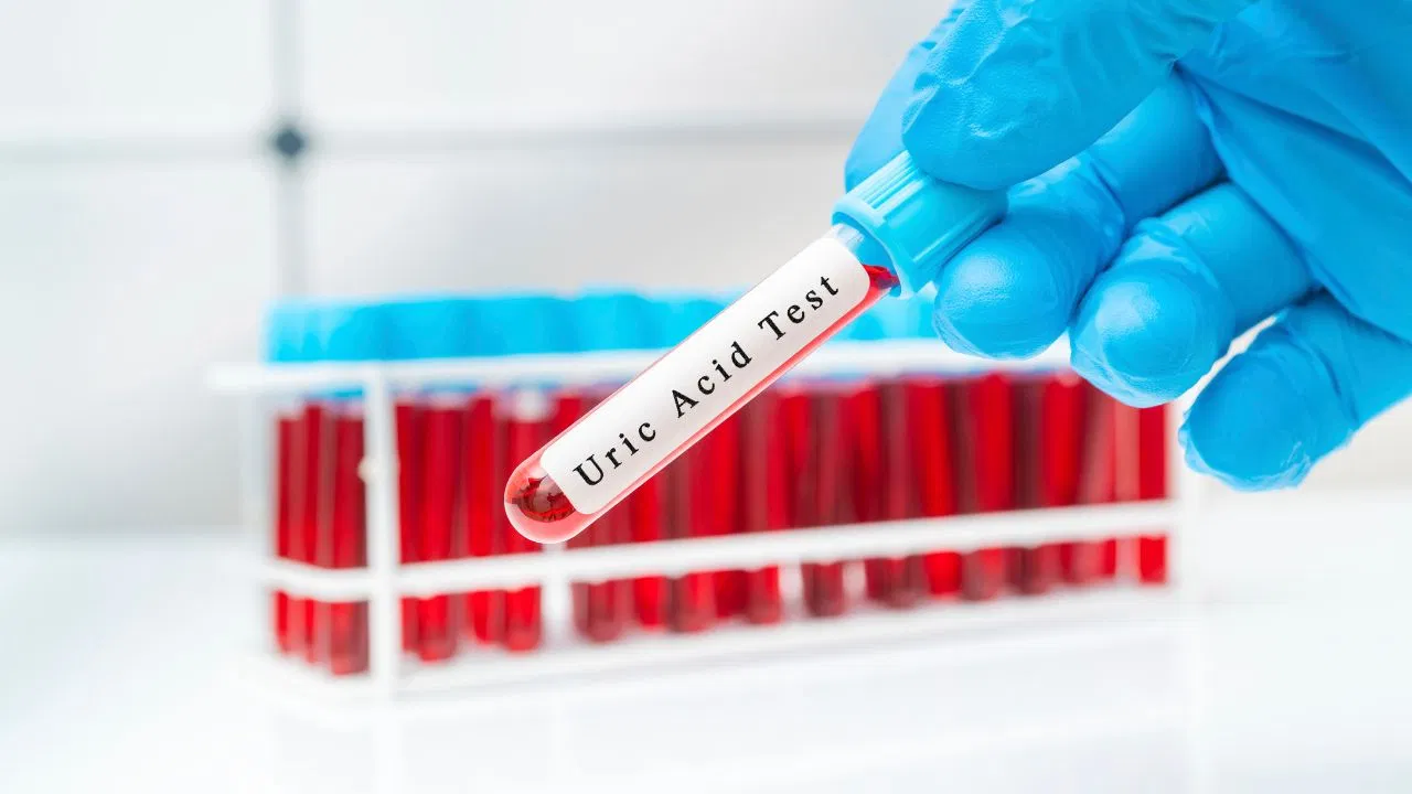 Uric acid: सर्दियों में हो रहा है जोड़ों में दर्द और सूजन, जानें ये किस बीमारी से हैं, कौन सा टेस्ट कराएं Uric acid: सर्दियों में हो रहा है जोड़ों में दर्द और सूजन, जानें ये किस बीमारी से हैं, कौन सा टेस्ट कराएं