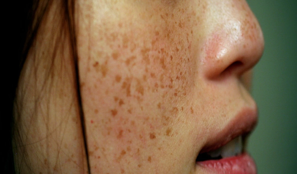 Health Tips: आपकी Skin दे रही है 5 गंभीर बीमारियों का Warning, इन लक्षणों को भूलकर भी न करें Ignore Health Tips: आपकी Skin दे रही है 5 गंभीर बीमारियों का Warning, इन लक्षणों को भूलकर भी न करें Ignore