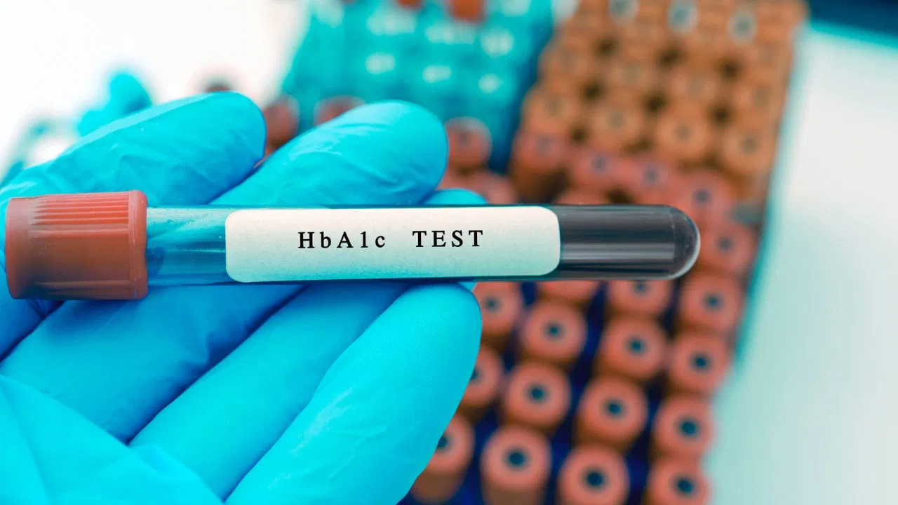 क्या HbA1c टेस्ट से पकड़ में नहीं आती डायबिटीज? जानें विशेषज्ञों की राय क्या HbA1c टेस्ट से पकड़ में नहीं आती डायबिटीज? जानें विशेषज्ञों की राय