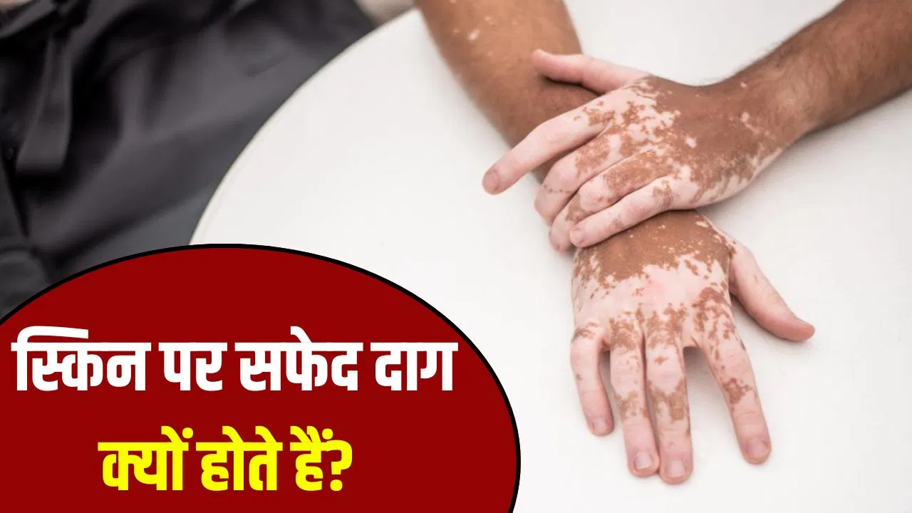 बच्चों की स्किन पर सफेद दाग विटिलिगो की बीमारी है या विटामिन की कमी? बच्चों की स्किन पर सफेद दाग विटिलिगो की बीमारी है या विटामिन की कमी?